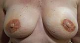 Areola After