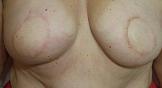 Areola Before