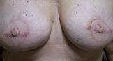 Areola Intermediate