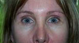 Liner Before